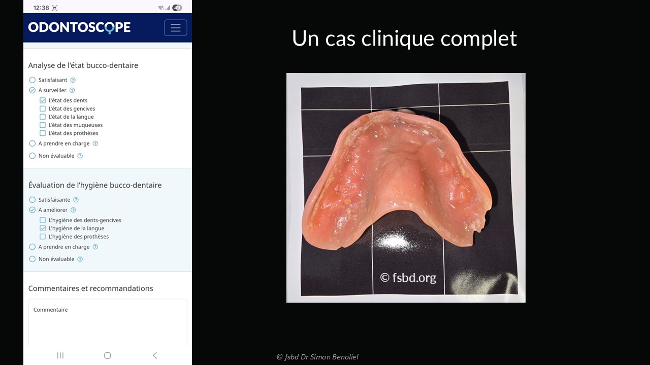 cas clinique prothèse
